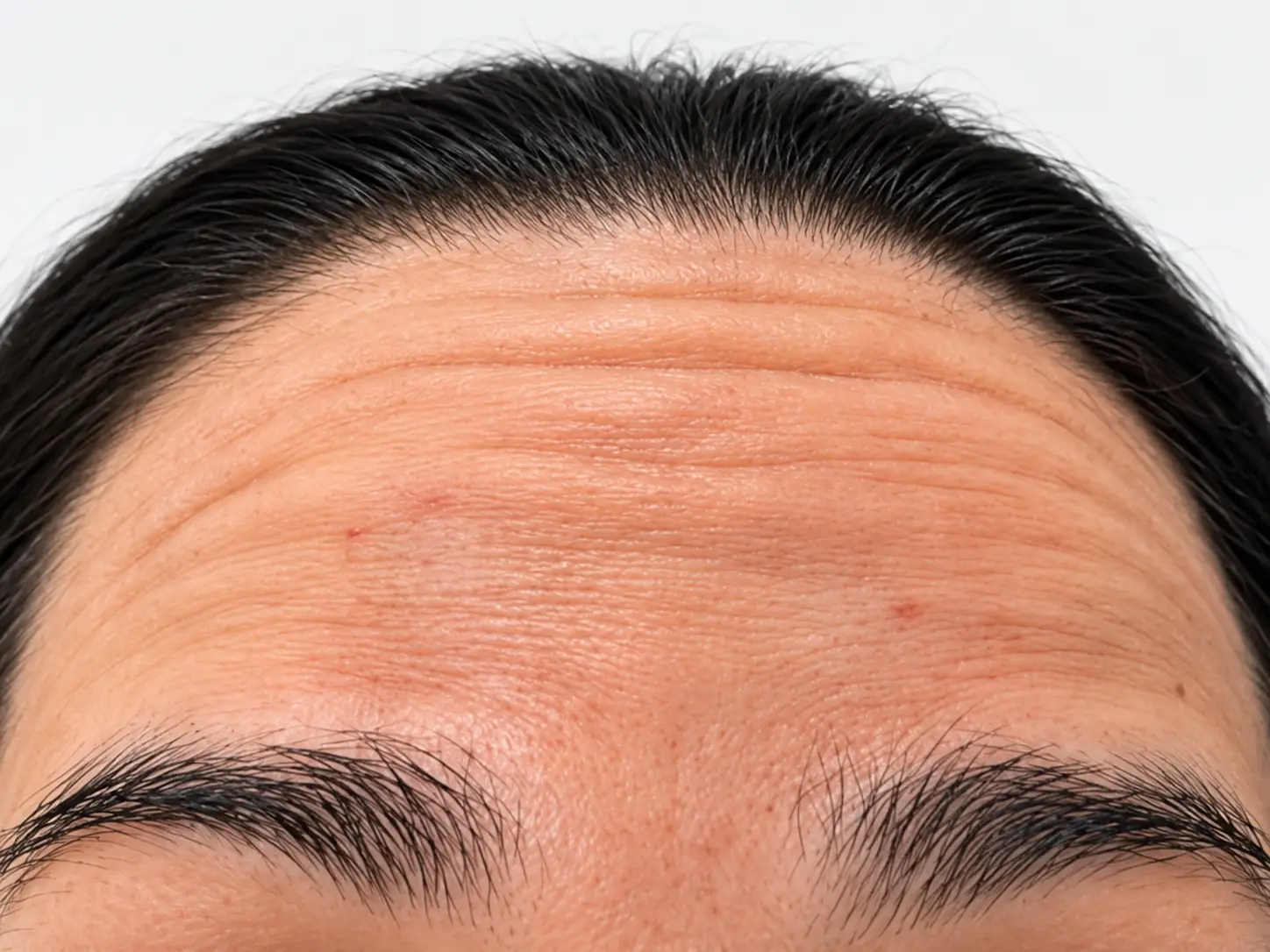 Testa antes do Botox