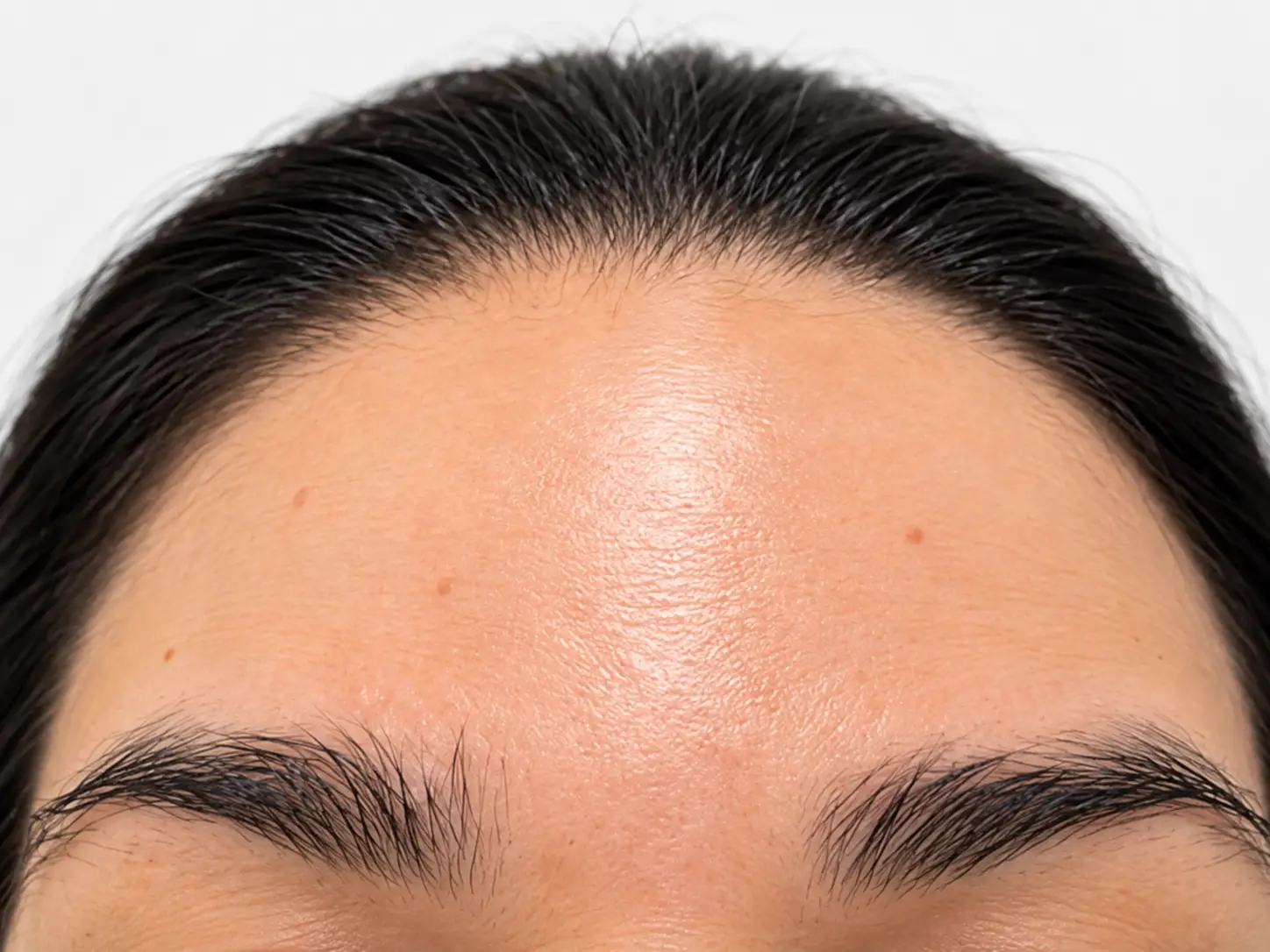Testa depois do Botox