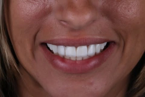 Sorriso depois do clareamento