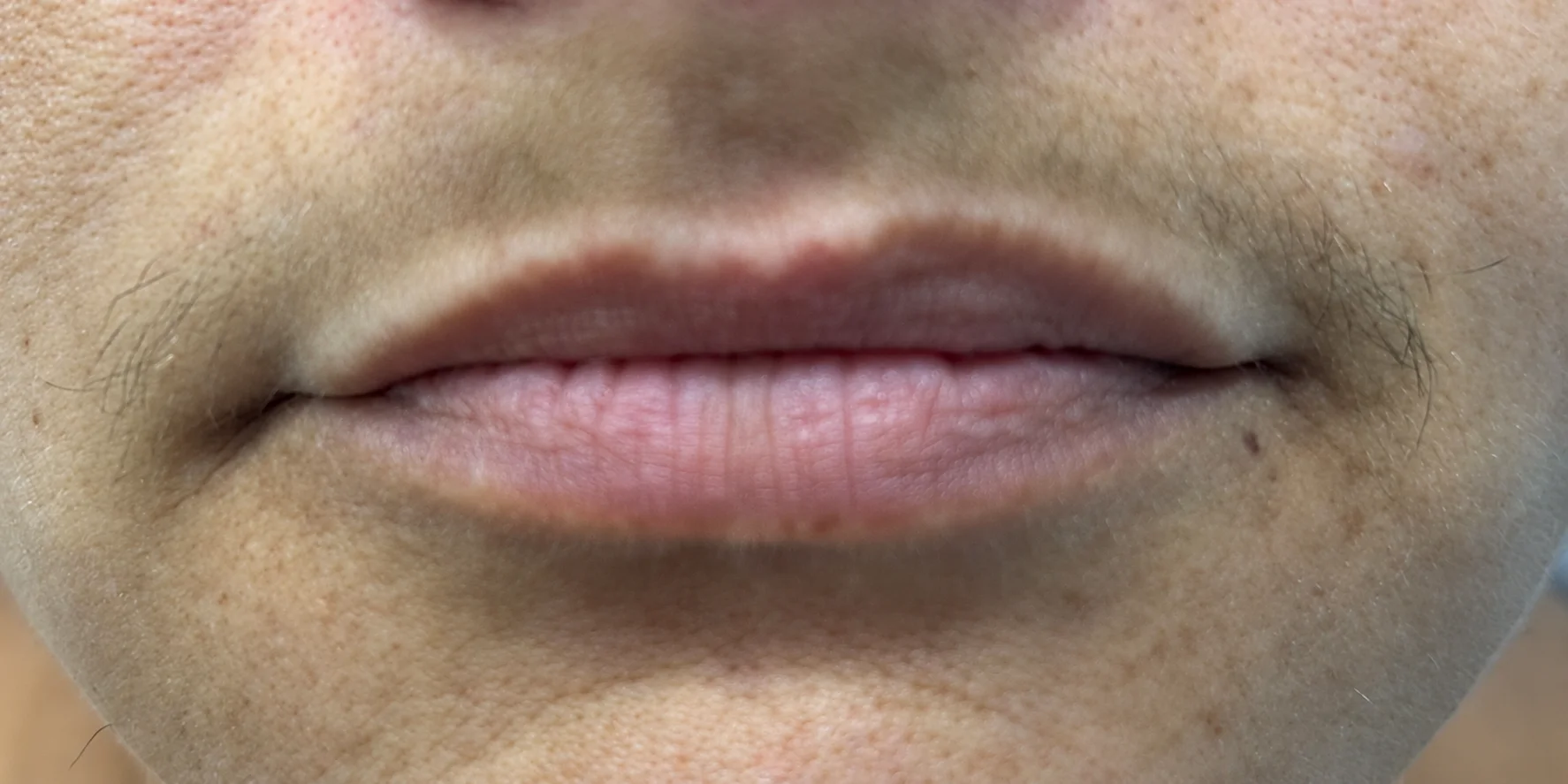 Lábios antes do preenchimento labial